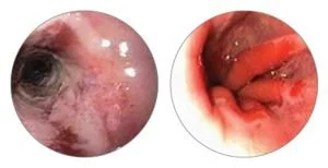 Upper endoscopy