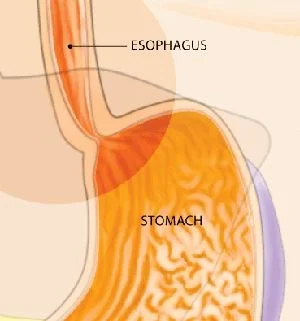 Barrett's Esophagus