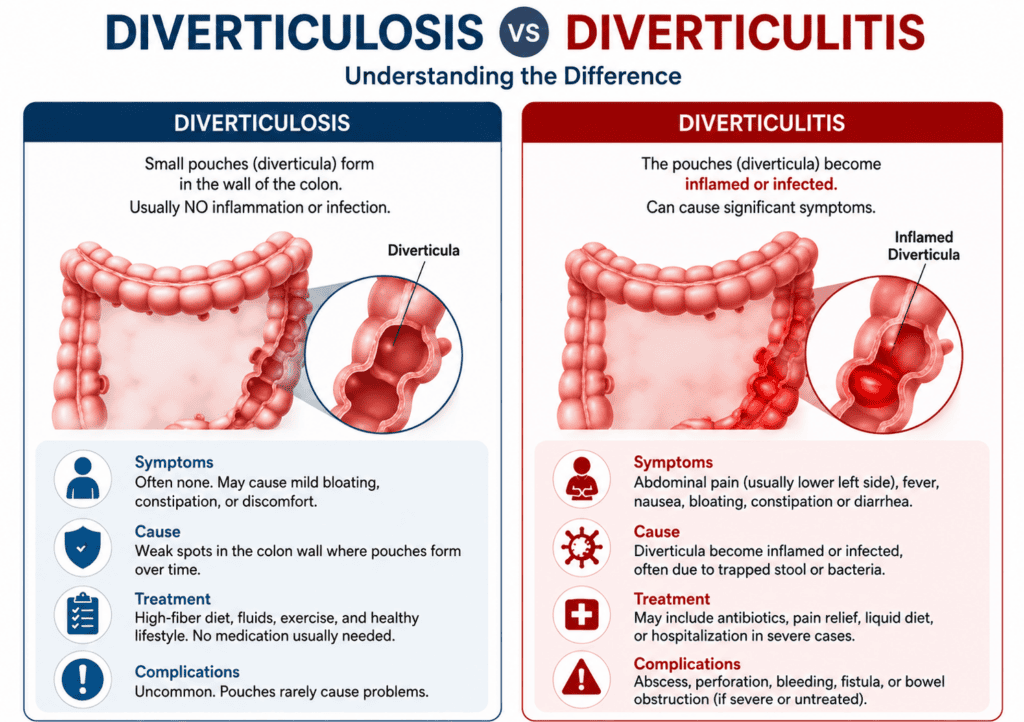 diverticulosis vs diverticulitis
