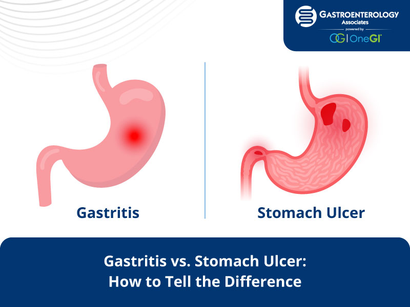 Gastritis vs. Stomach Ulcer
